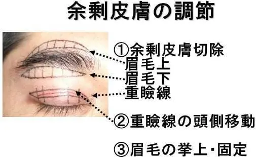 上瞼のシワとり治療方法